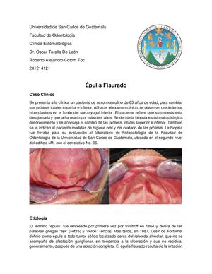 Caso Épulis Fisurado