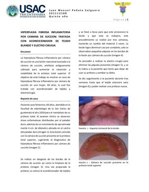 Hiperplasia Fibrosa Inflamtoria Por Camara De Succion