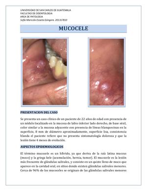 Mucocele