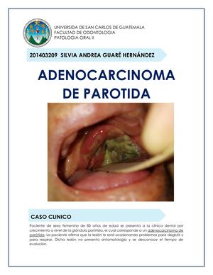 Adenocarcinoma de Parótida