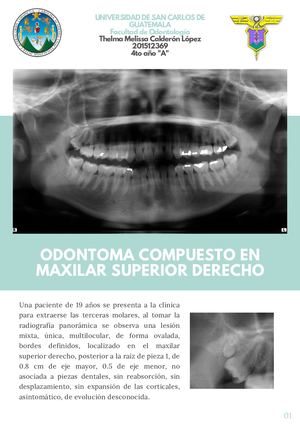 Odontoma Compuesto