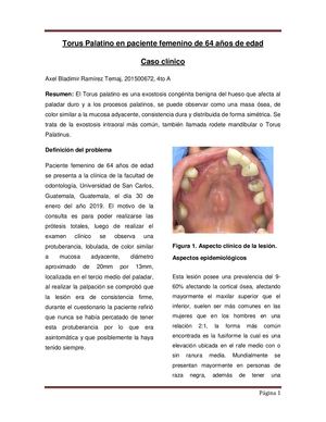 Torus Palatino En Paciente Femenino De 64 Años De Edad