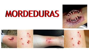Mordeduras