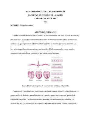 Arritmias Cardiacas