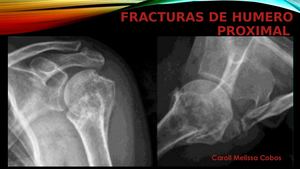 Fracturas Humero Proximal