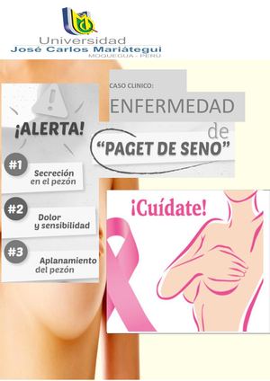 enfermedad de Paget mamaria
