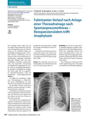 11 Fulminanter Verlauf Nach Anlage Einer Thoraxdrainage Nach Spontanpneumothorax – Reexpansionsödem Trifft Anaphylaxie