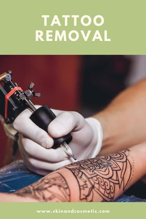 Tattoo Removal At Kathmandu Clinic Of Cosmetic Surgery