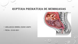Ruptura Prematura De Membranas