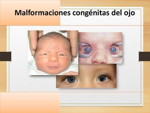 P 10 Malformaciones Congénitas Del Ojo