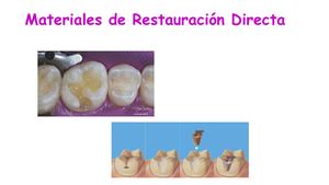 Materiales De Restauración Directa