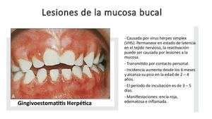 Lesiones De La Mucosa Bucal Y Cirugía Bucal