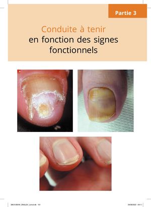 L'ONGLE : DE LA CLINIQUE AU TRAITEMENT 2023