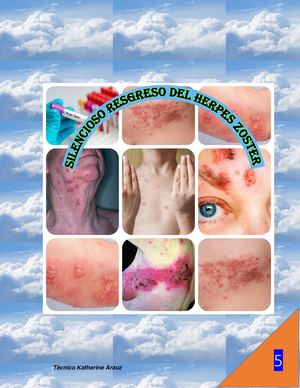 Silencioso regreso del Herpes Zóster