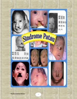 Síndrome De Patau Adelanto Trabajo Terminado