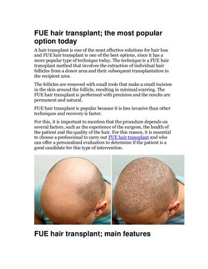 Calaméo - Fue Hair Transplant; The Most Popular Option Today