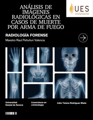 ANALISIS DE IMAGENES RADIOLOGICAS EN CASOS DE MUERTE POR ARMA DE FUEGO (Radiología Forense)