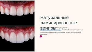 Natural Laminate Veneers