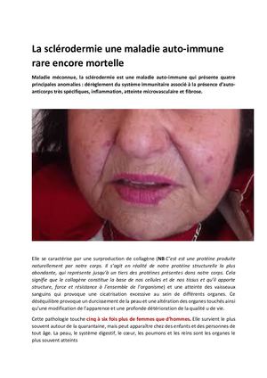 La Sclérodermie une affection auto - Immune rare encore mortelle