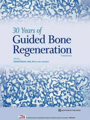 30 Years Of Guided Bone Regeneration In Implant