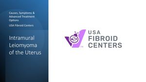 Non-Surgical Relief from Intramural Leiomyoma of Uterus | USA Fibroid Centers