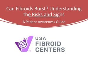 Can Fibroids Burst Understanding Symptoms, Risks, And Treatment