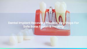 Dental Implant Recovery Process: Key Steps For Safe Bone Fusion & Healing